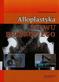 Alloplastyka stawu biodrowego